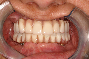 Implant Dentistry After Photo